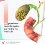 02 possíveis complicações de pedra na vesícula Dr Christiano Claus