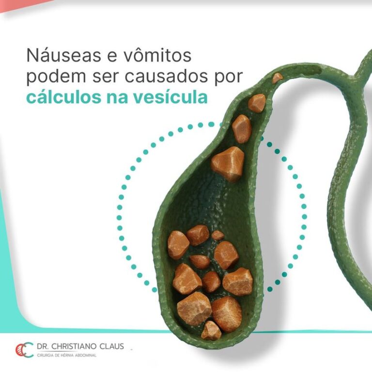 Náuseas e vômitos podem ser causados por cálculos na vesícula Dr