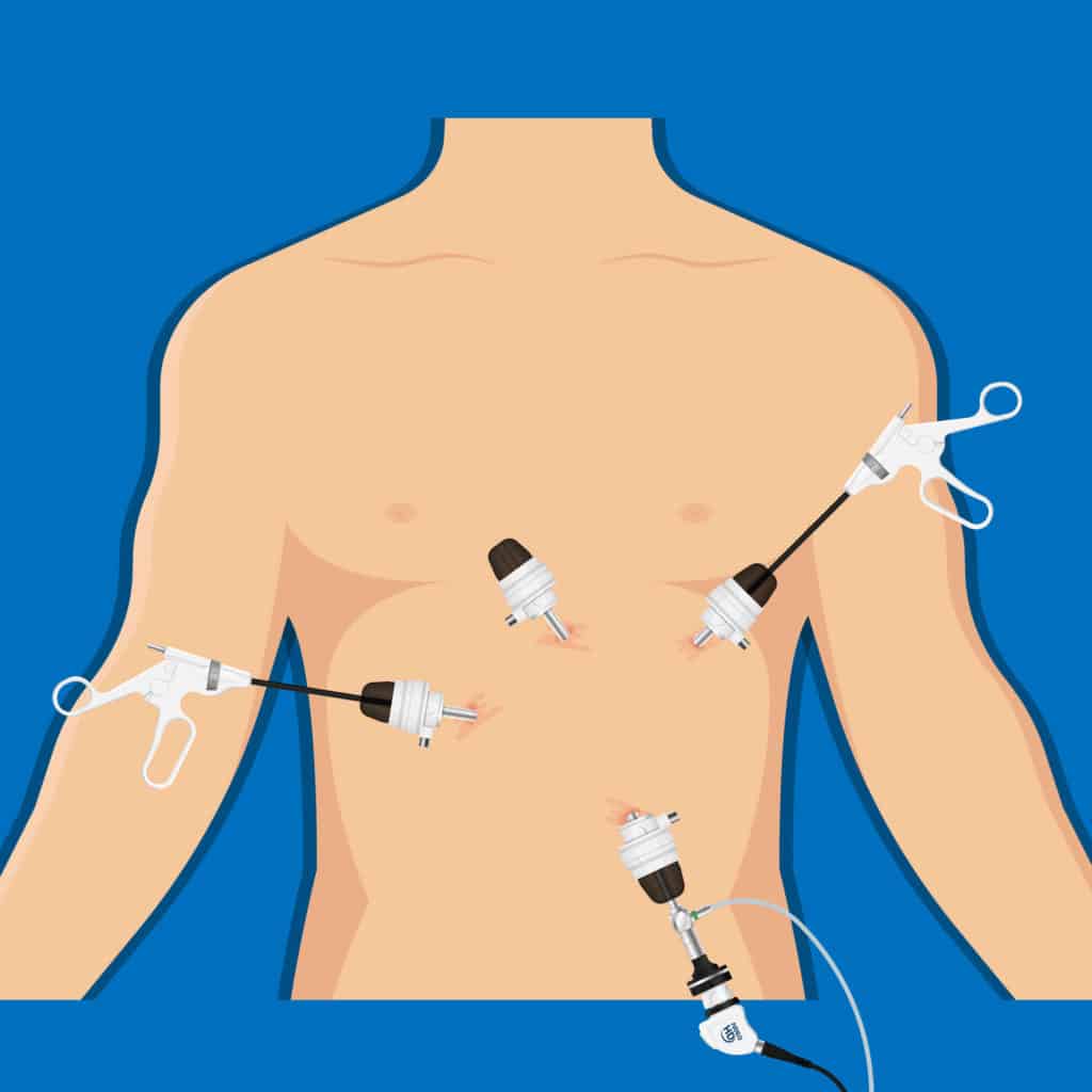 6 passos para recuperação após cirurgia de hérnia de hiato - SBH