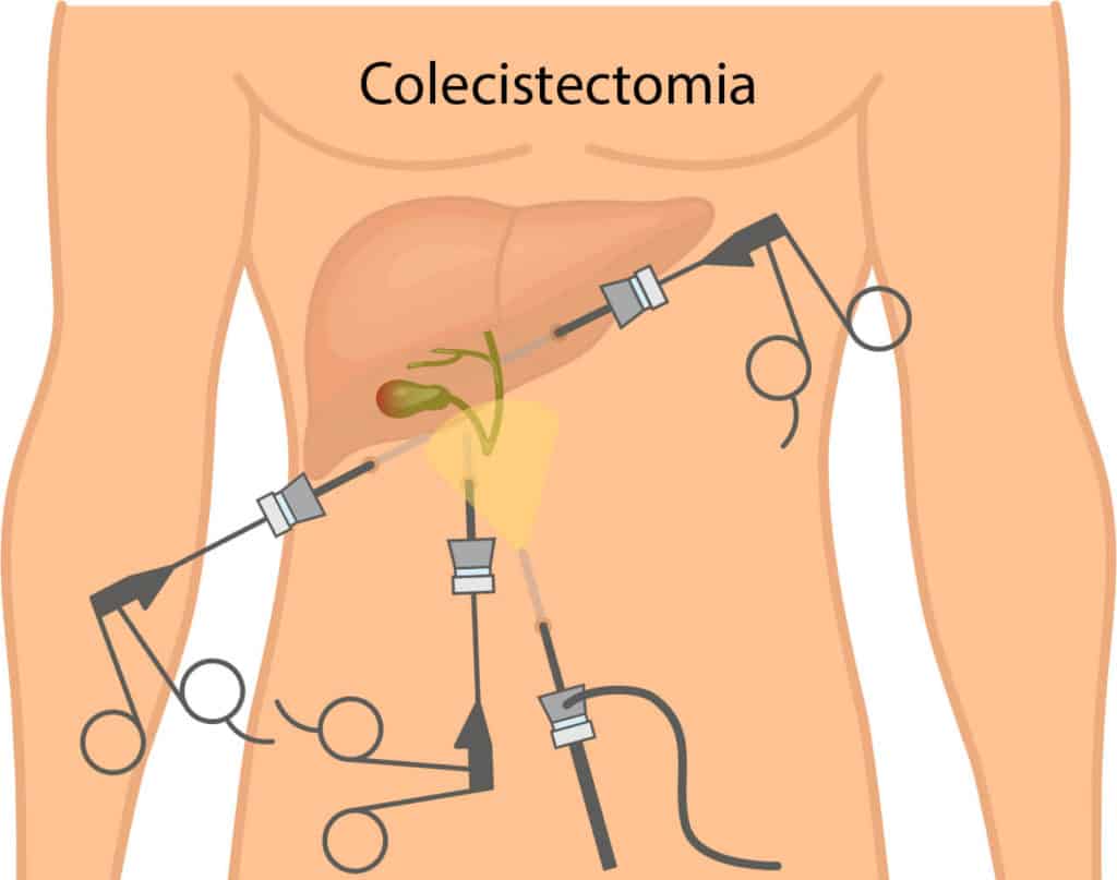 Quem fez cirurgia de vesícula pode se abaixar? Confira aqui!