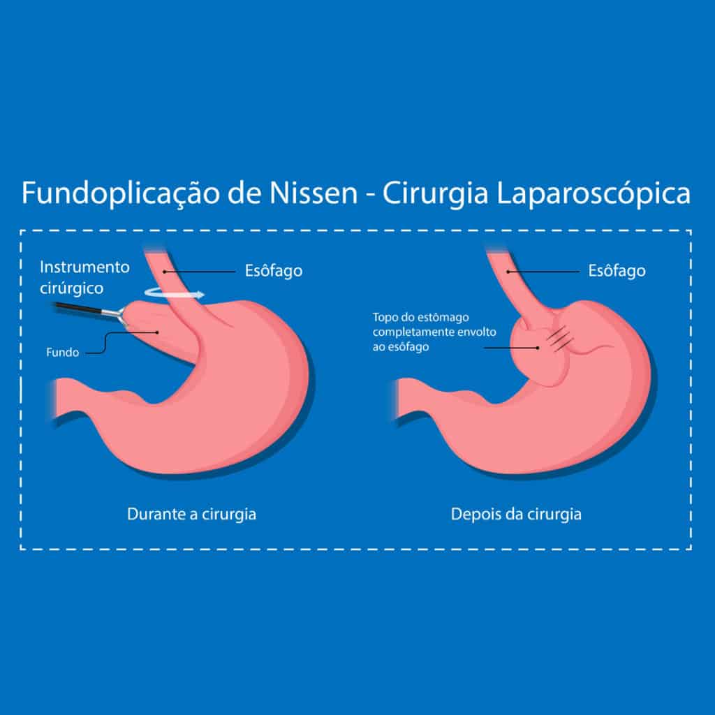 6 passos para recuperação após cirurgia de hérnia de hiato - SBH