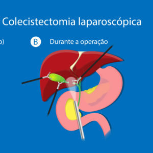 Colecistectomia - Cirurgia