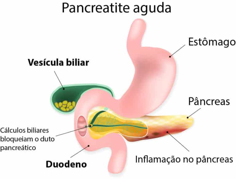 Cirurgia de Pedra na Vesícula Dr Christiano Claus