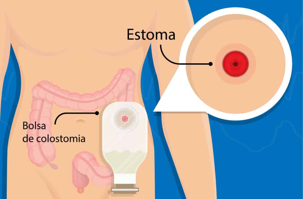 Terapia de manutenção após ooforoplastia devido endometrioma diminui  recorrência? - PEBMED