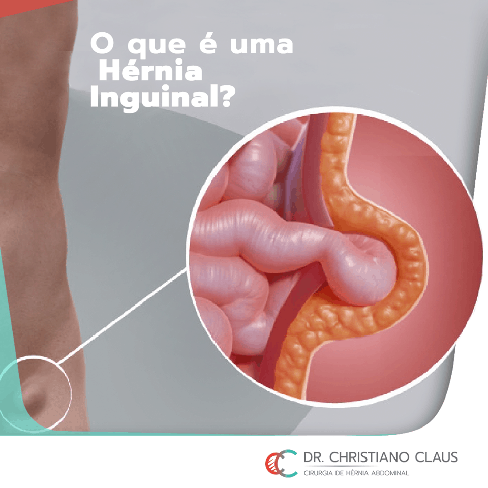 Principais características das hérnias inguinais – Dr. Christiano Claus