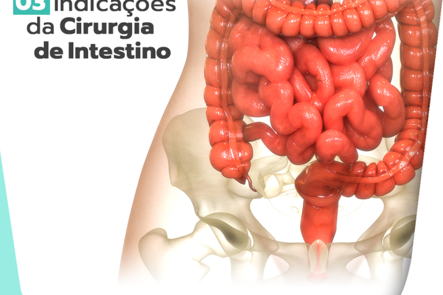 3 indicações da cirurgia de intestino
