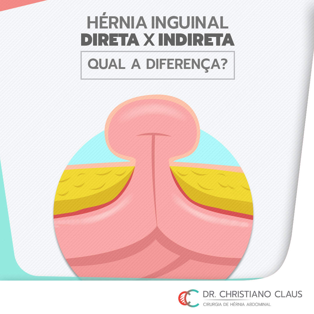 O que é uma hérnia inguinal? – Dr. Christiano Claus