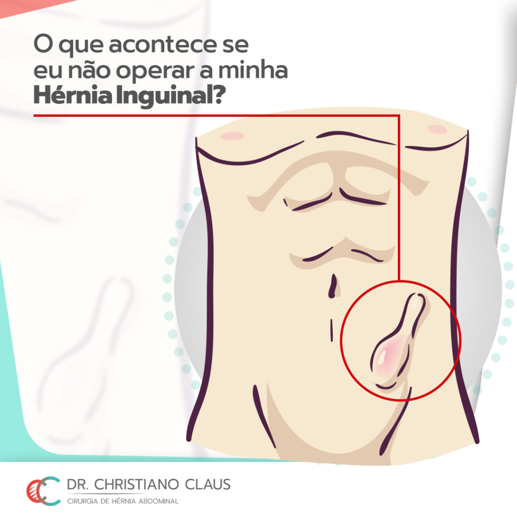O que pode dar errado na Cirurgia de Hérnia Inguinal? • Café Cirúrgico