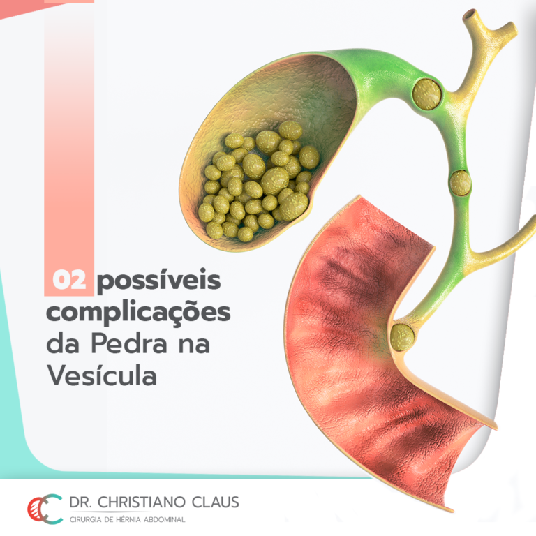 Quem Tem Pedra Na Vesicula Pode Tomar Cafe Com Leite