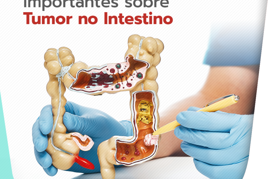 05 fatos importantes sobre tumor de intestino