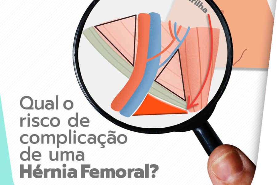 Qual é o risco de complicação de uma hérnia femoral?