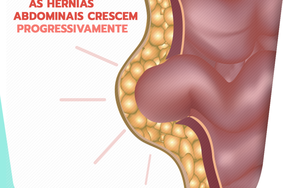 Fato ou Fake: as hérnias abdominais crescem progressivamente?