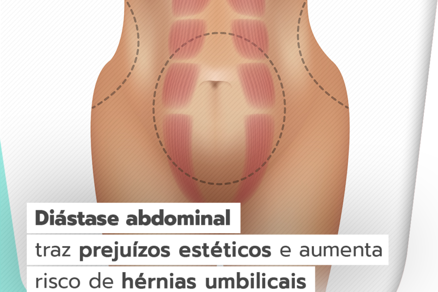 Diástase abdominal traz prejuízos estéticos e aumenta risco de hérnias umbilicais