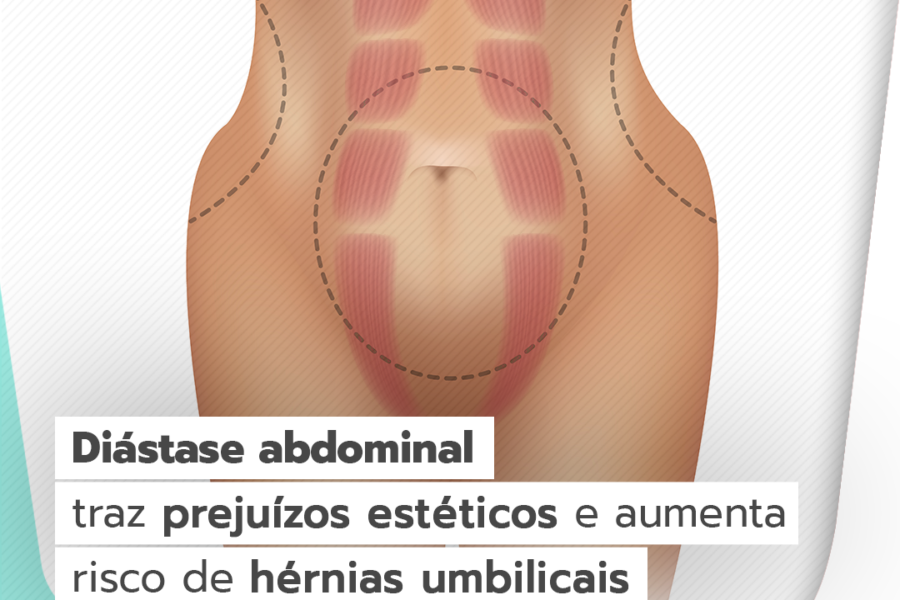 7 fatores de risco para a hérnia inguinal - SBH