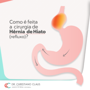 Como é feita a cirurgia de hérnia de hiato? (refluxo) – Dr. Christiano ...