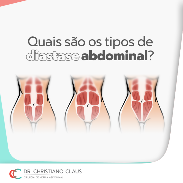 Quais são os tipos de diástase abdominal Dr Christiano Claus