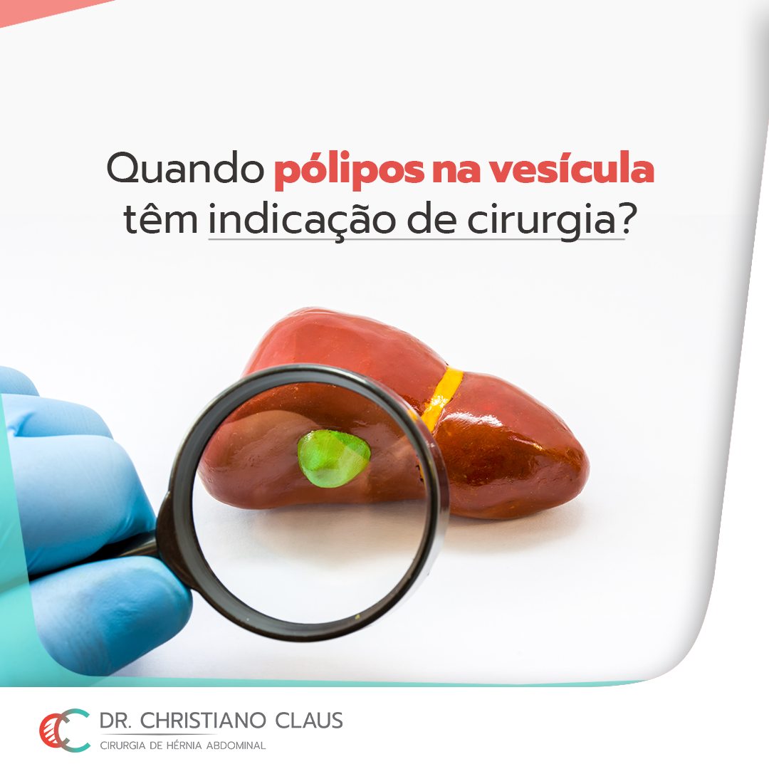 Quando Pólipos Na Vesícula Tem Indicação De Cirurgia Dr Christiano