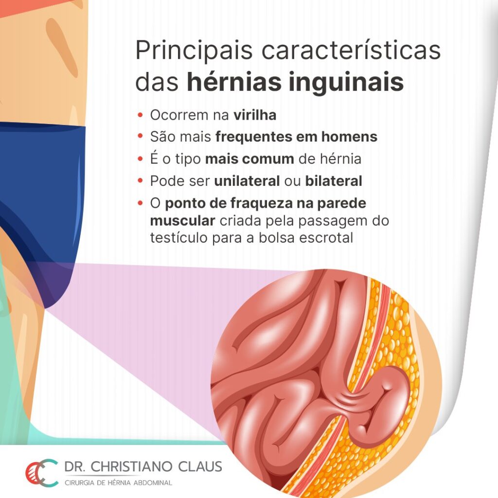 Principais características das hérnias inguinais – Dr. Christiano Claus