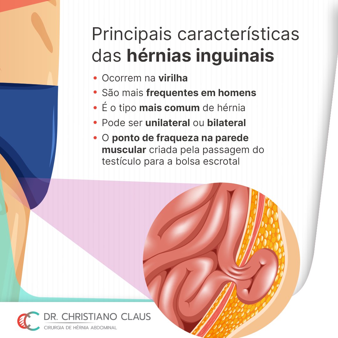 Características clínicas e diagnóstico das hérnias inguinais e femorais /  Blog Jaleko