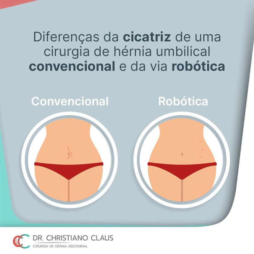 Diferenças na cicatriz de uma cirurgia de hérnia convencional e via  robótica – Dr. Christiano Claus
