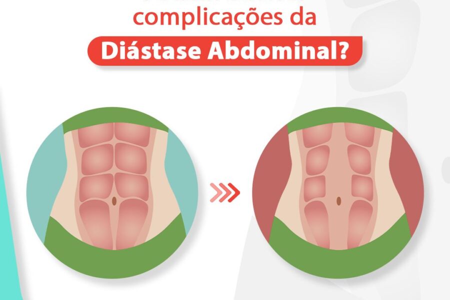 Podem ocorrer complicações da diastase abdominal?