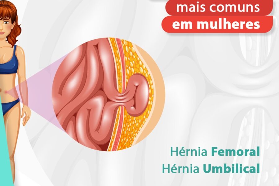Tipos de hérnias mais comuns em mulheres