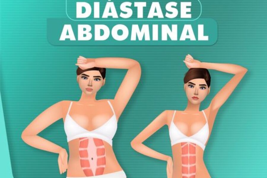 Conheça as principais causas da diástase abdominal
