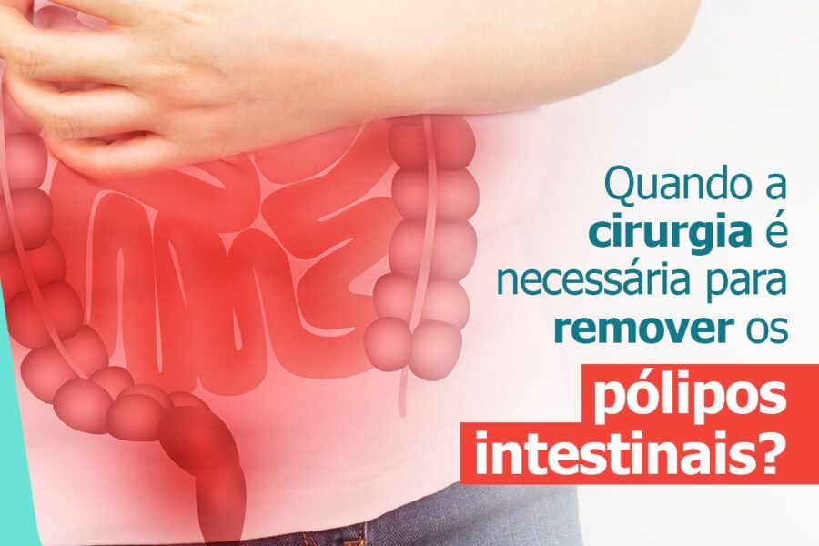 Quando a cirurgia é necessária para remover os pólipos intestinais?